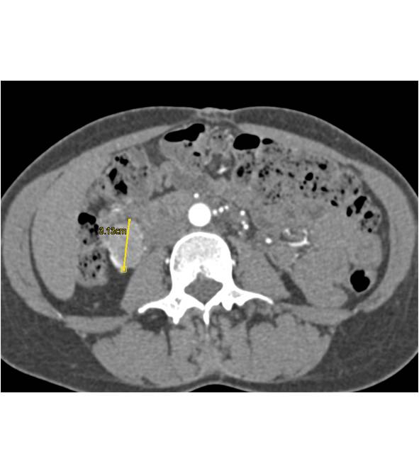 GIST Tumor of the Duodenum (vascular) - CTisus CT Scan