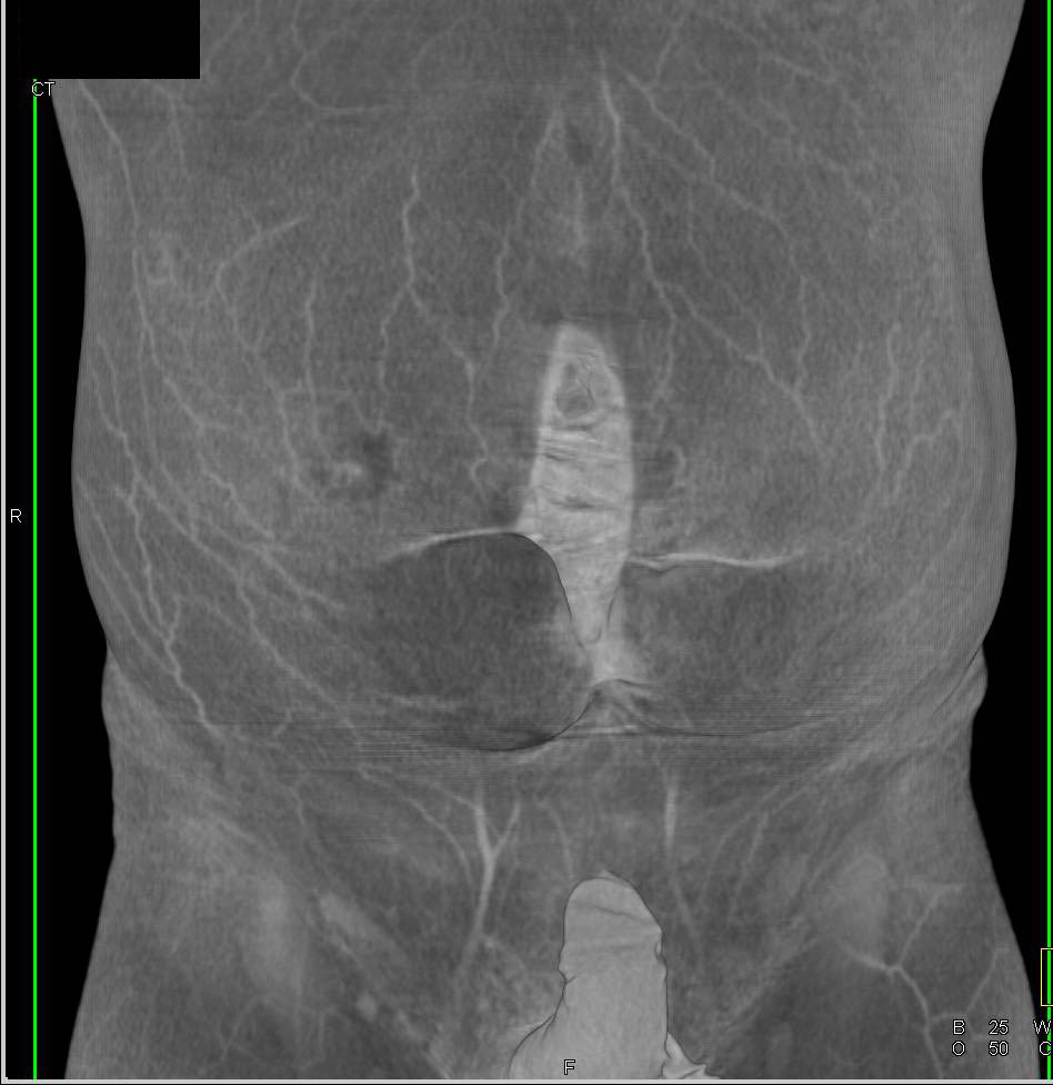 Small Bowel Obstruction Due To Incisional Hernia In Abdominal Wall