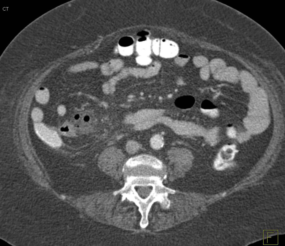 Ileal Diverticulitis - CTisus CT Scan