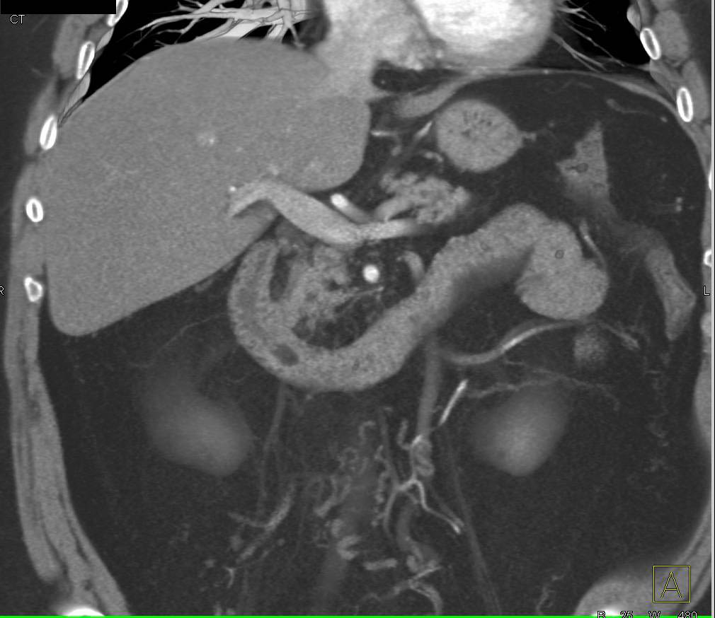 Lipoma of the Duodenum and Multiple Renal Arteries - CTisus CT Scan