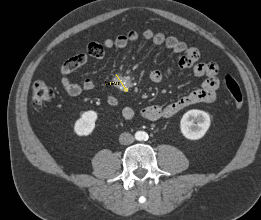 Carcinoid Tumor in the Root of the Mesentery with Desmoplastic Reaction - CTisus CT Scan