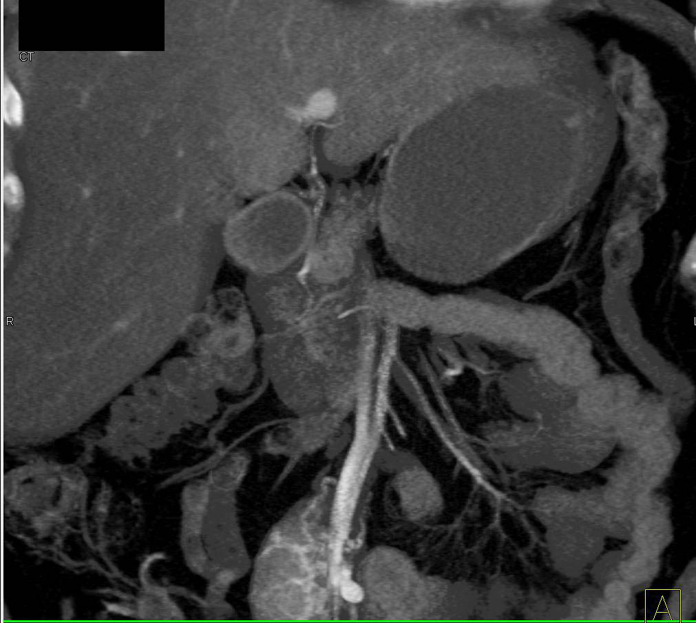 Carcinoid Tumor in the root of the Mesentery with Desmoplastic Reaction - CTisus CT Scan