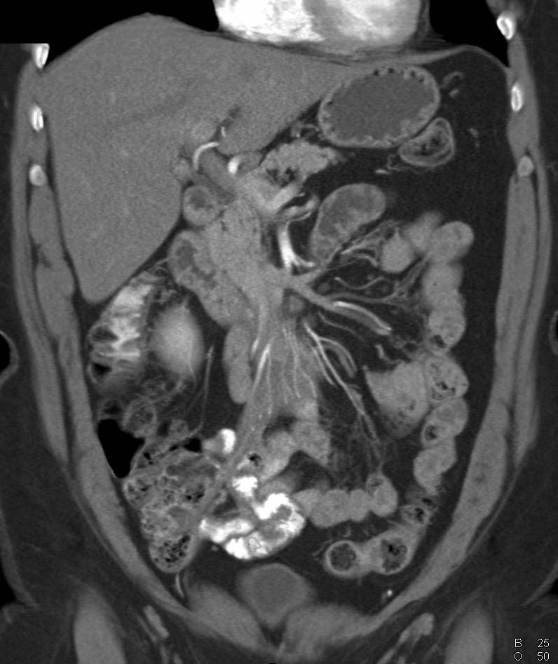 Sclerosing Mesenteritis Simulates a Carcinoid Tumor - CTisus CT Scan