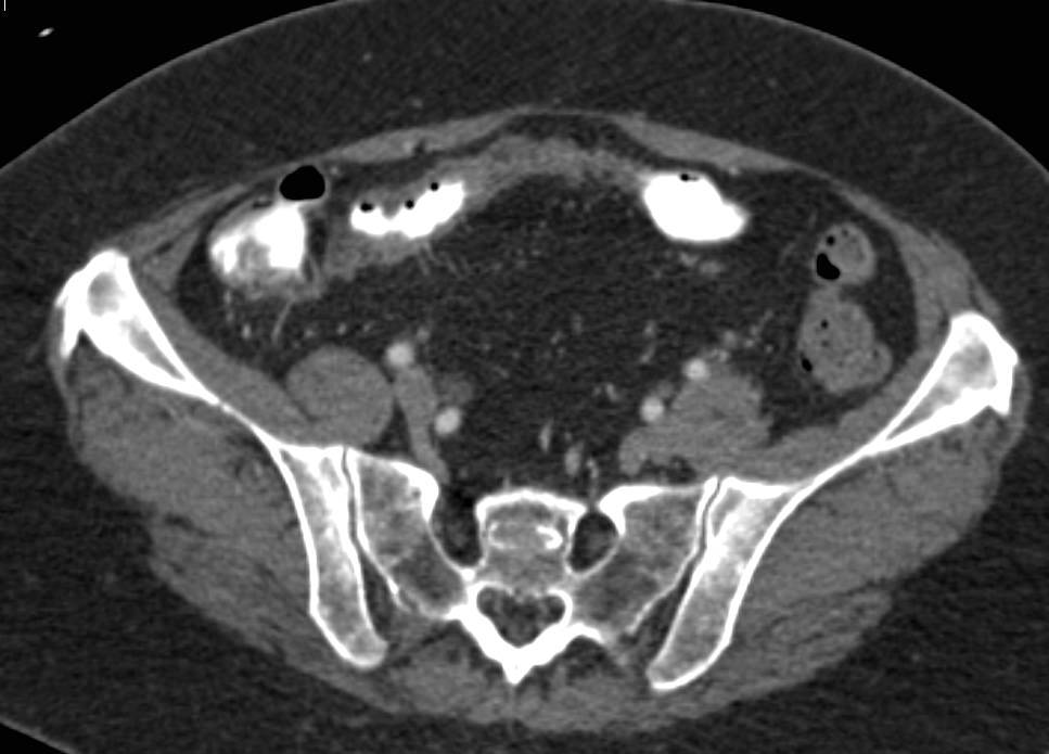 Crohn's Disease of the Terminal Ileum with Strictures - CTisus CT Scan