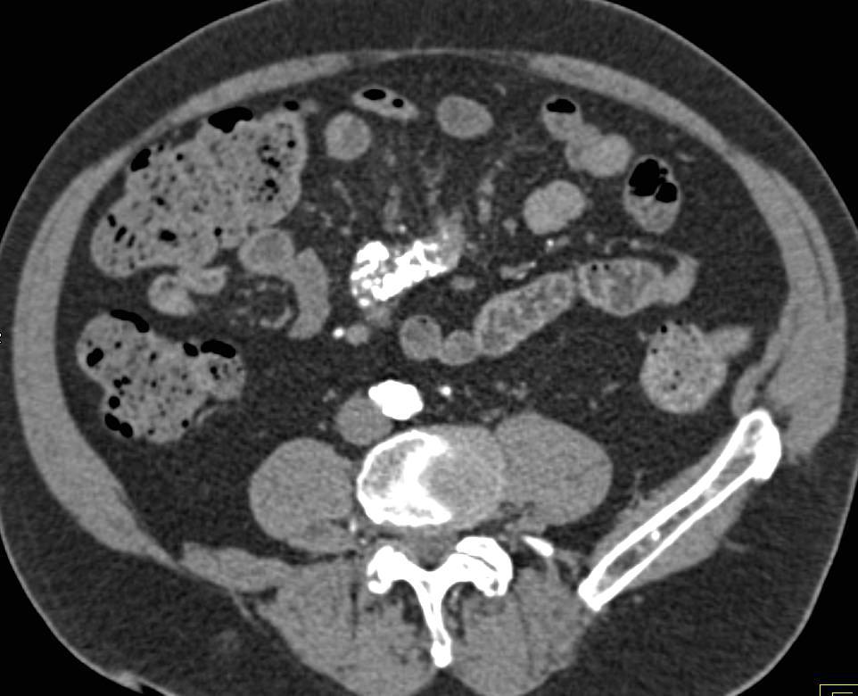 Sclerosing Mesenteritis Simulating a Carcinoid Tumor - CTisus CT Scan