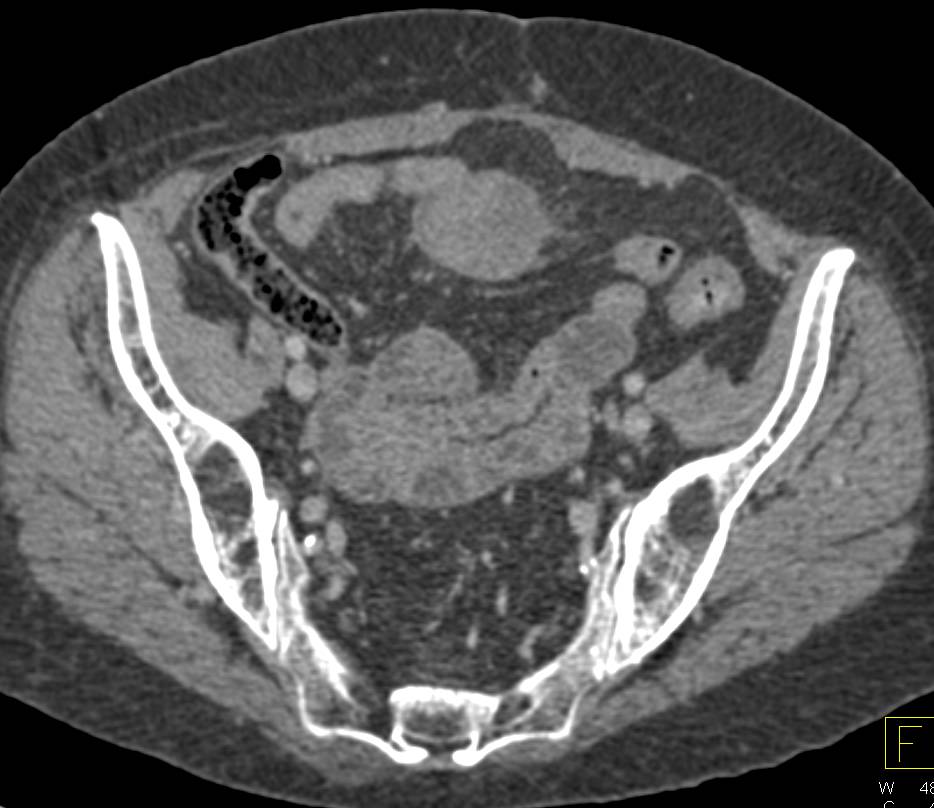 Desmoid Tumor in Root of Mesentery - CTisus CT Scan