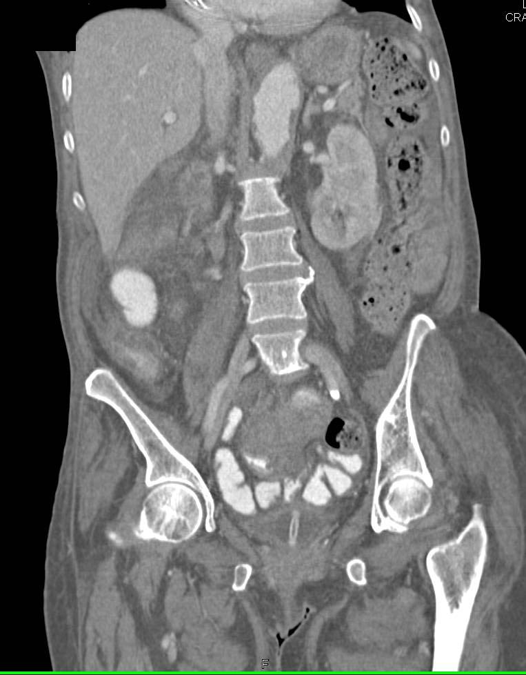 Adenocarcinoma of the Small Bowel - CTisus CT Scan