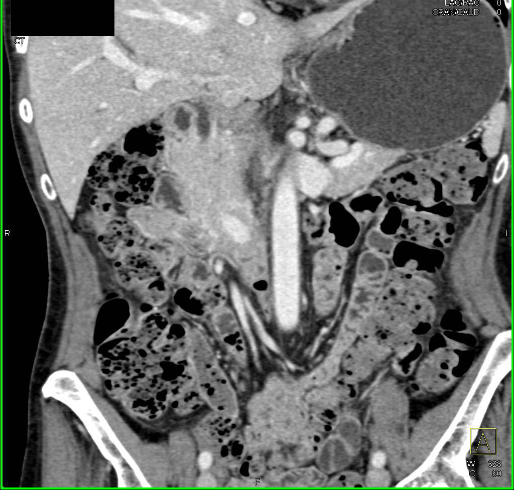 Feces Sign in Small Bowel without Obstruction - CTisus CT Scan