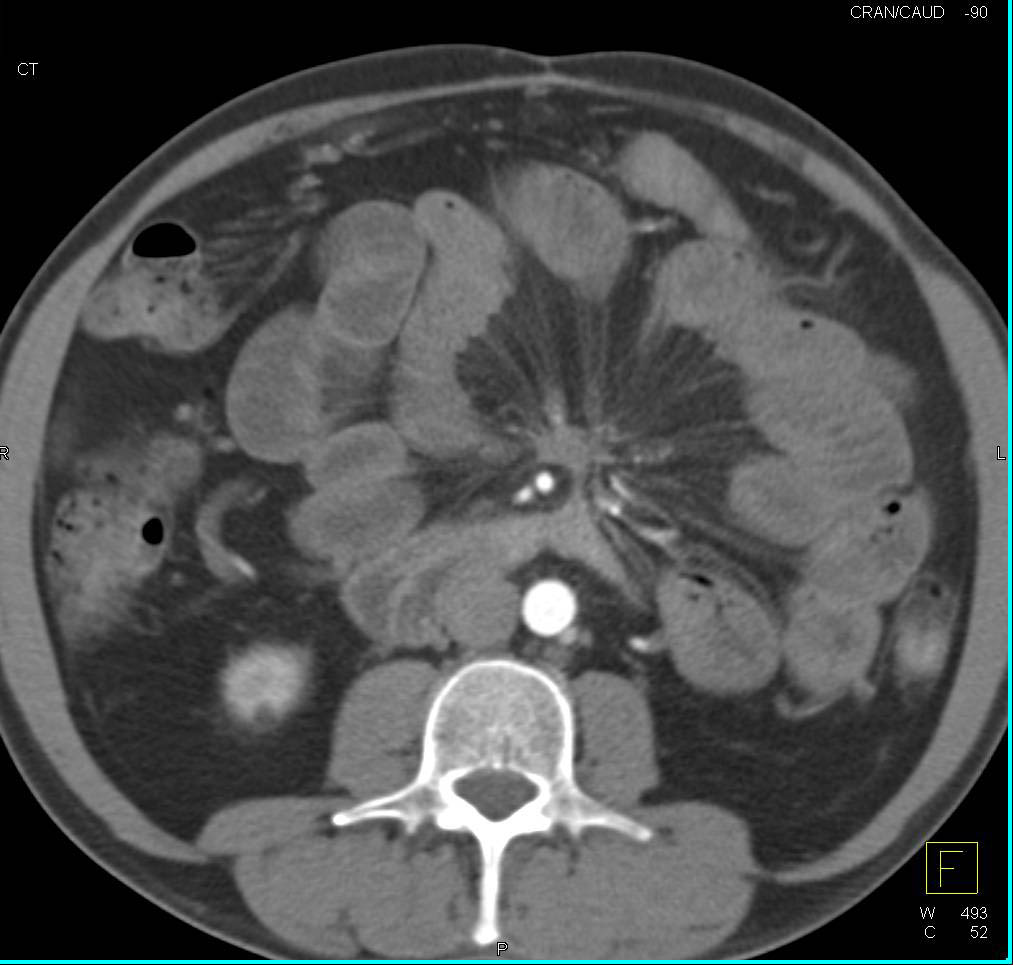 Carcinoid Tumor with Desmoplastic Reaction of Mesentery with Tethered Bowel Loops - CTisus CT Scan