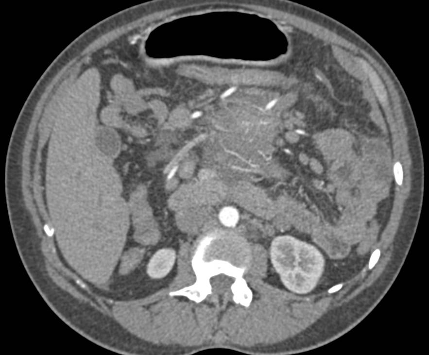 Large GIST Tumor with Neovascularity - CTisus CT Scan