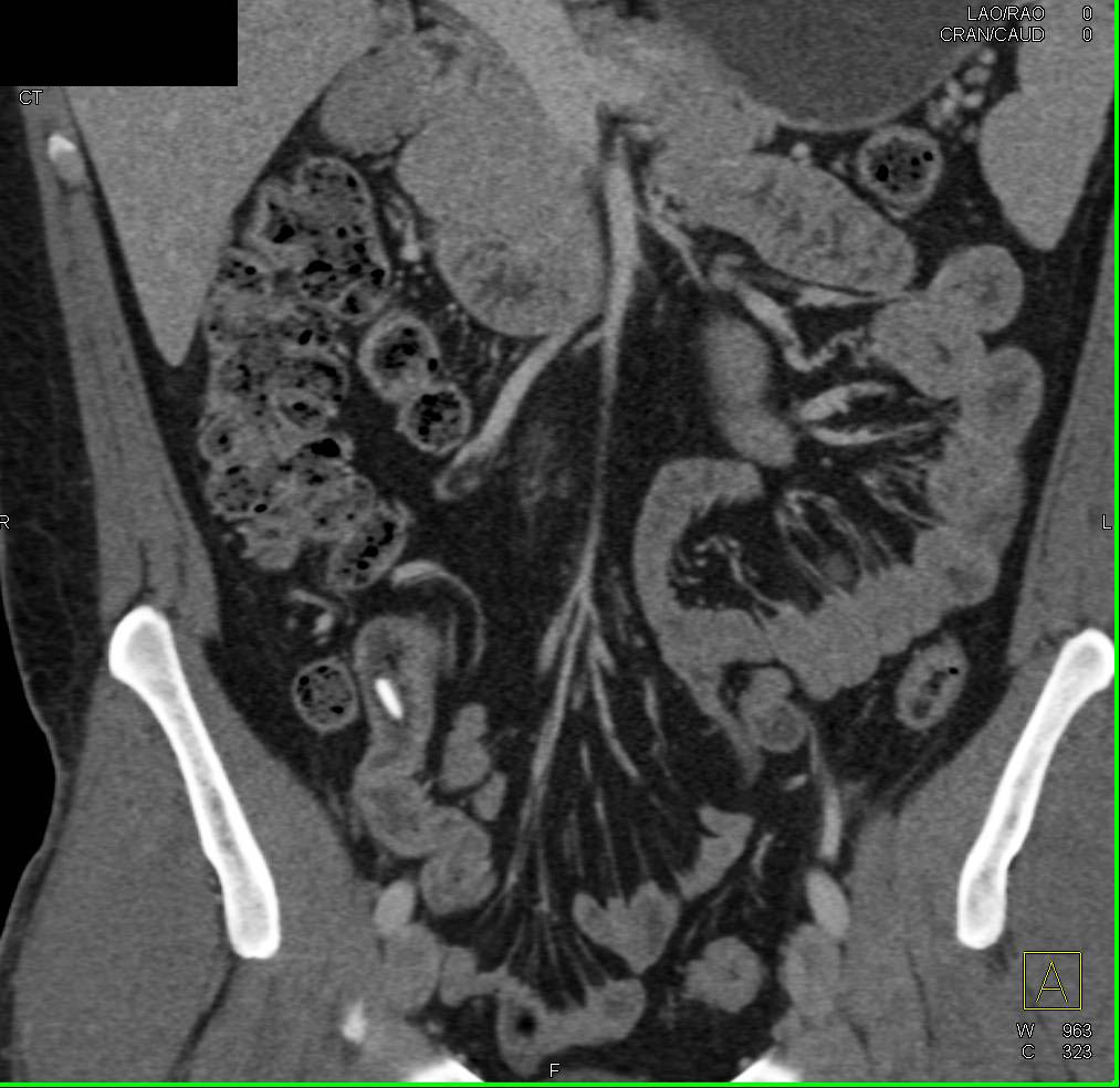 Swallowed Needle in Terminal Ileum - CTisus CT Scan