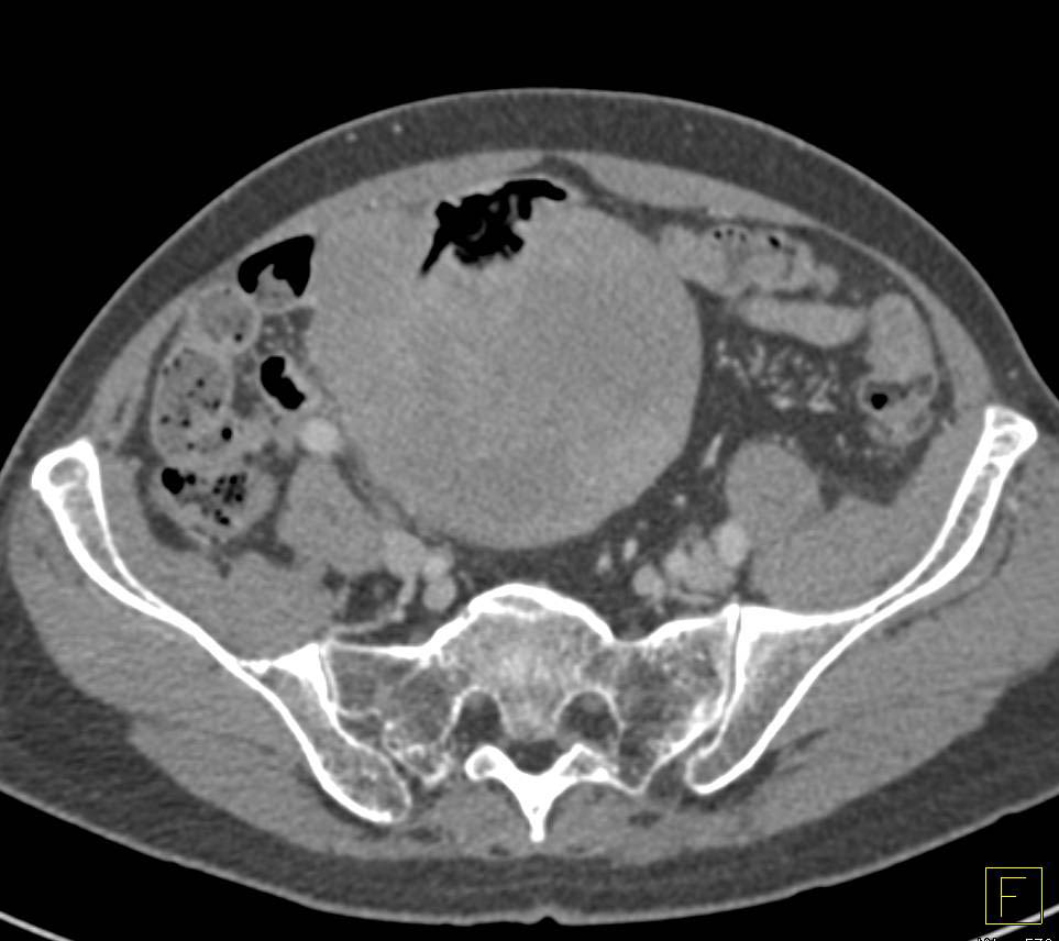 Lymphoma of the Ileum - CTisus CT Scan