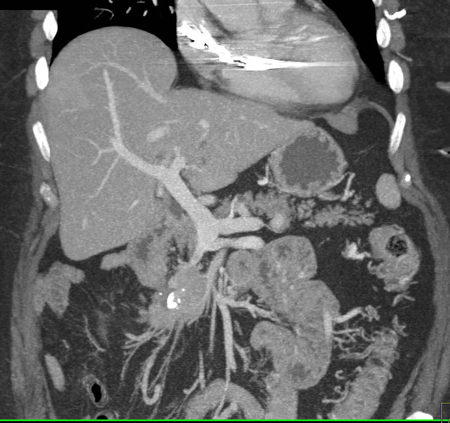 Carcinoid Tumor with Encasement of the Superior Mesenteric Vein (SMV) - CTisus CT Scan