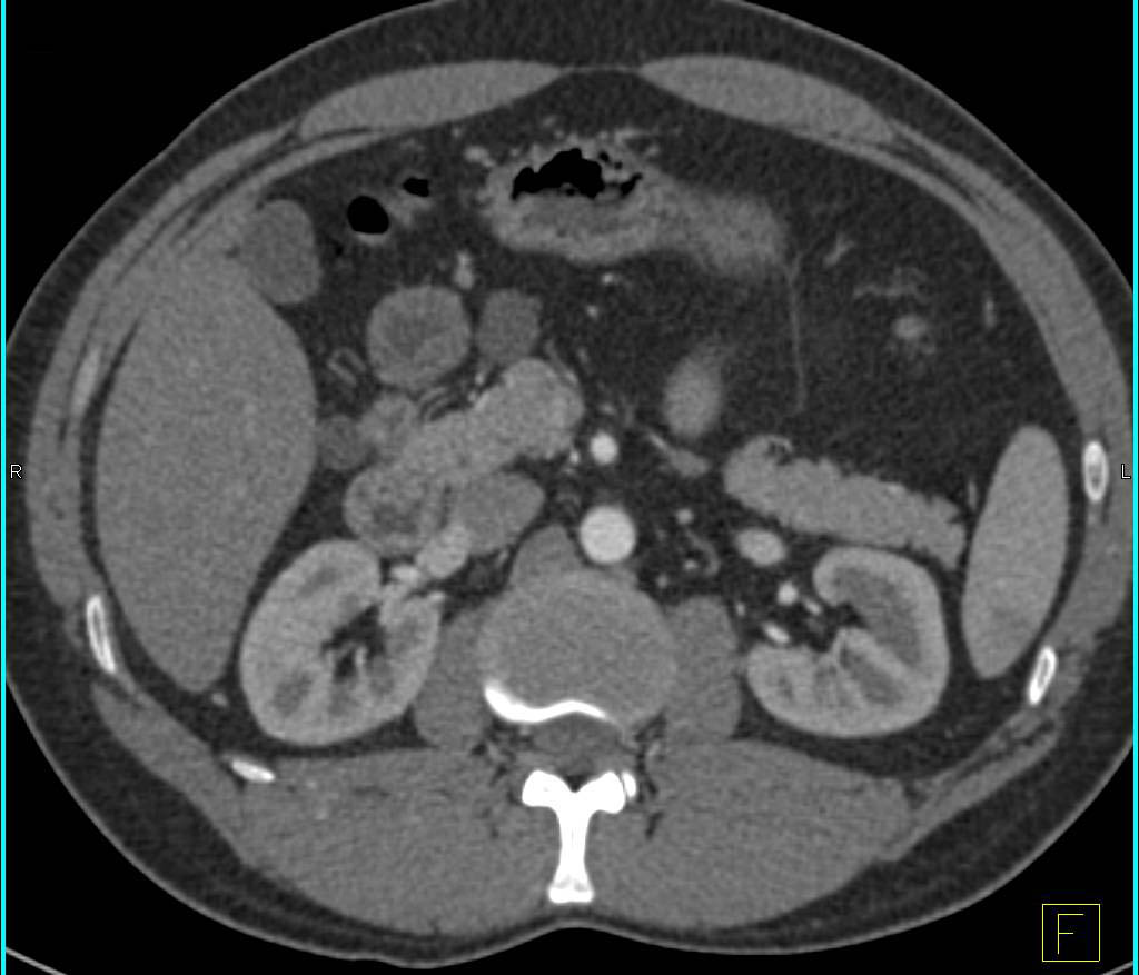 lymphangioma near the pancreatic head - CTisus CT Scan