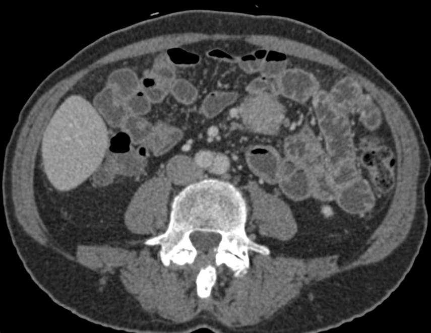 Carcinoid Tumor in Mesentery Encases the SMA - CTisus CT Scan