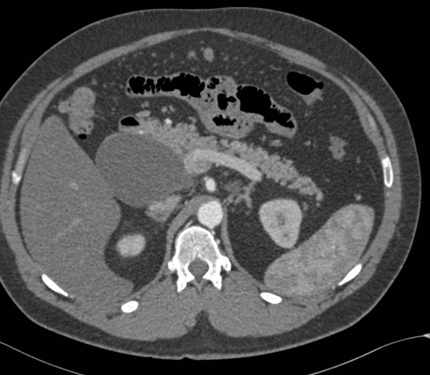GIST Tumor with Adenopathy - CTisus CT Scan