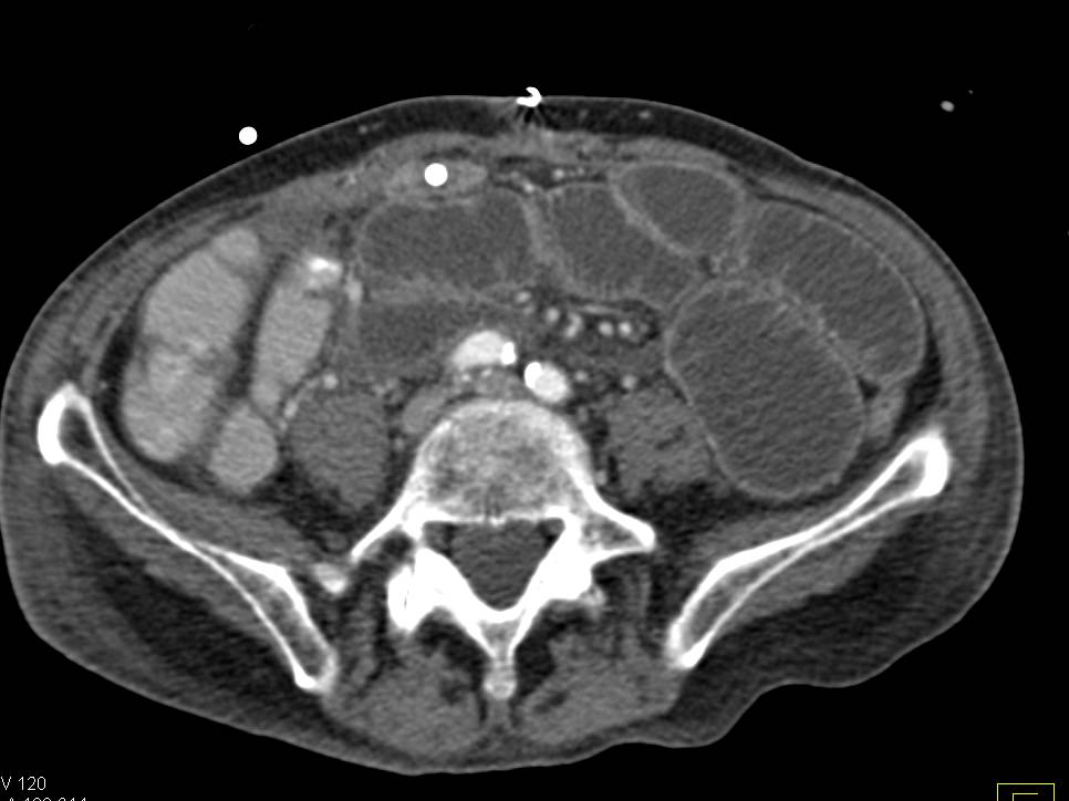 Small Bowel Obstruction due to Stricture as Shown on Coronal Views - CTisus CT Scan