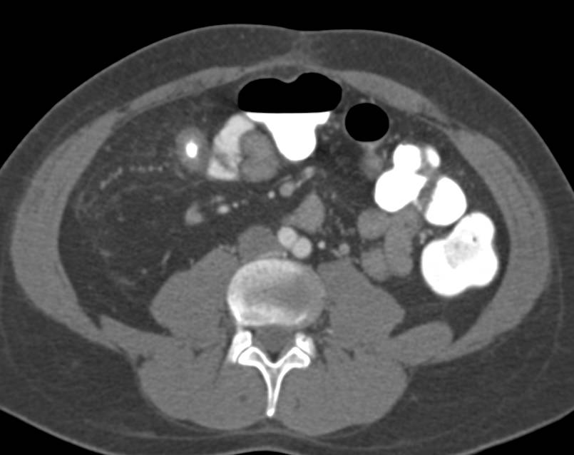 Crohn's Disease of the Terminal Ileum with Strictures - CTisus CT Scan