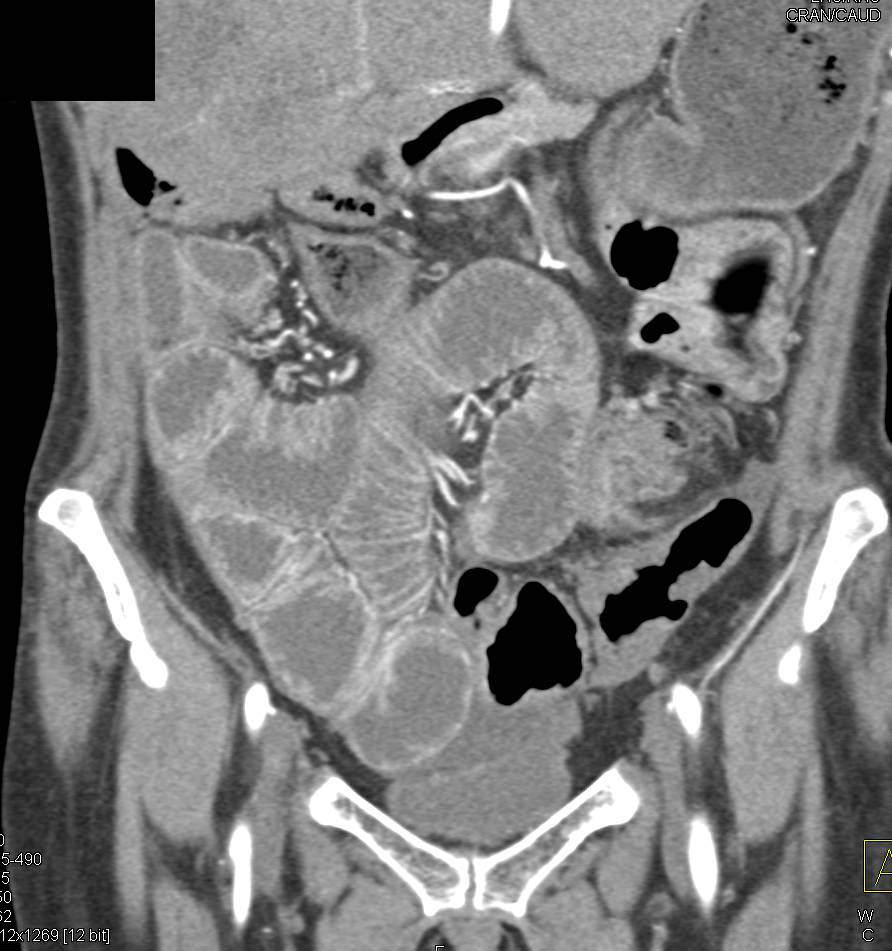Adhesions with Small Bowel Ileus - CTisus CT Scan