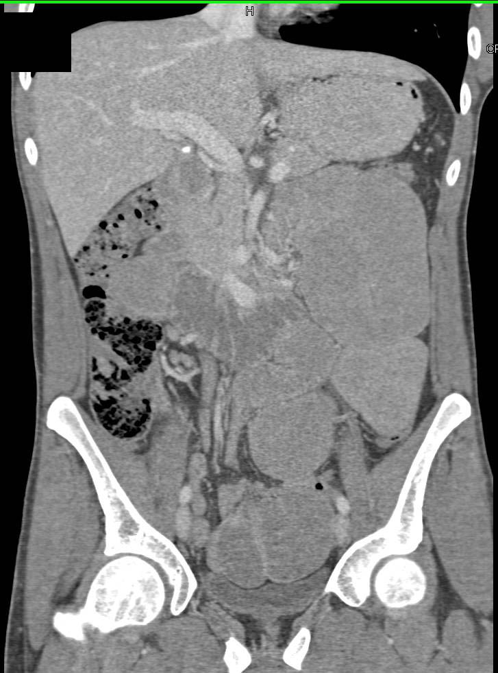 Small Bowel Obstruction due to Adhesions - CTisus CT Scan