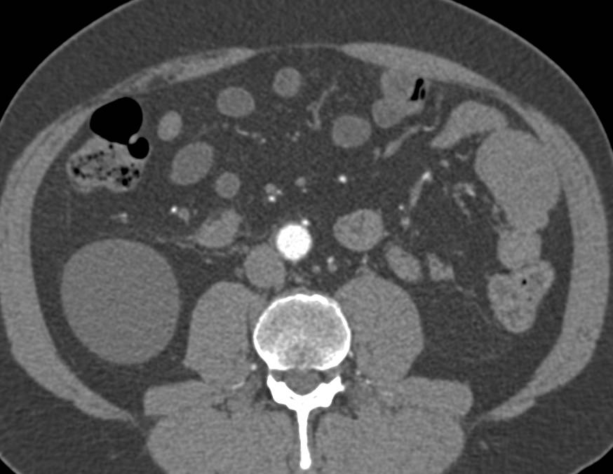 Focal Perforation off the 3rd Portion of the Duodenum - CTisus CT Scan