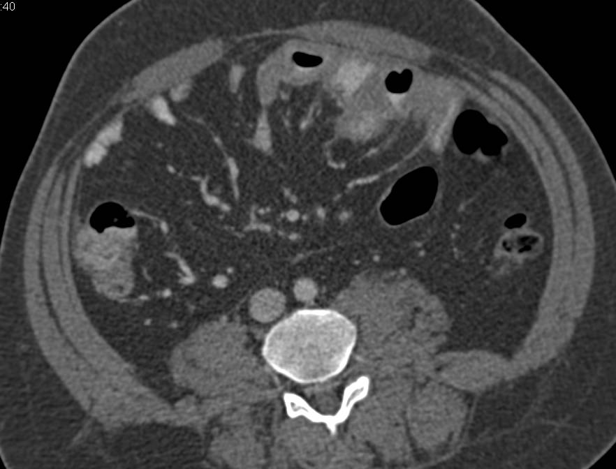 Crohn's Disease of the Small Bowel with Areas of Stenosis - CTisus CT Scan