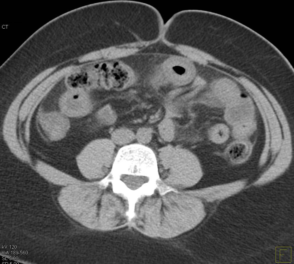 Crohn's Disease of the Small Bowel - CTisus CT Scan