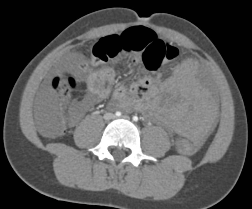 Intra-abdominal Bleed - CTisus CT Scan