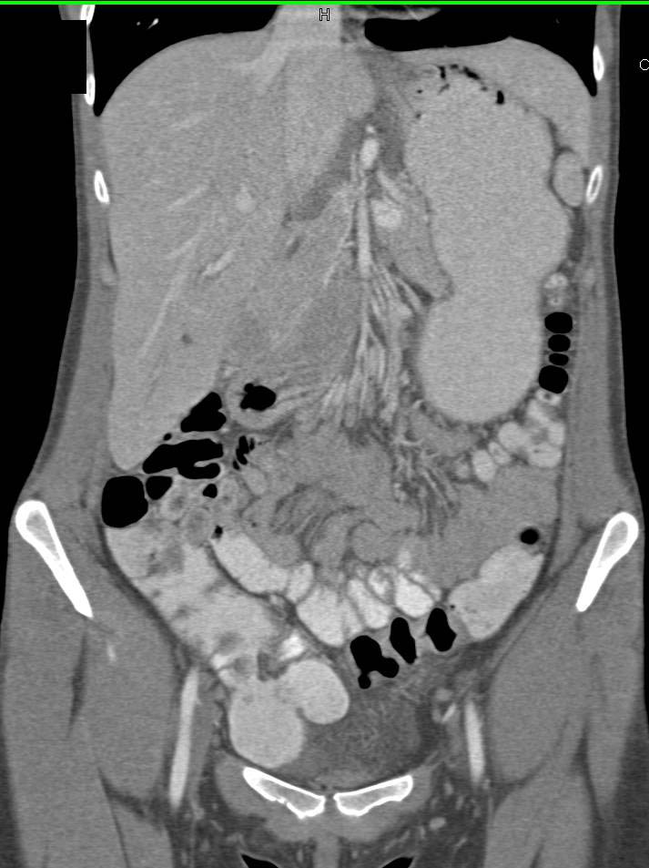 Mycobacterium avium/intracellulare (MAI) Infection with Mesenteric Adenopathy - CTisus CT Scan