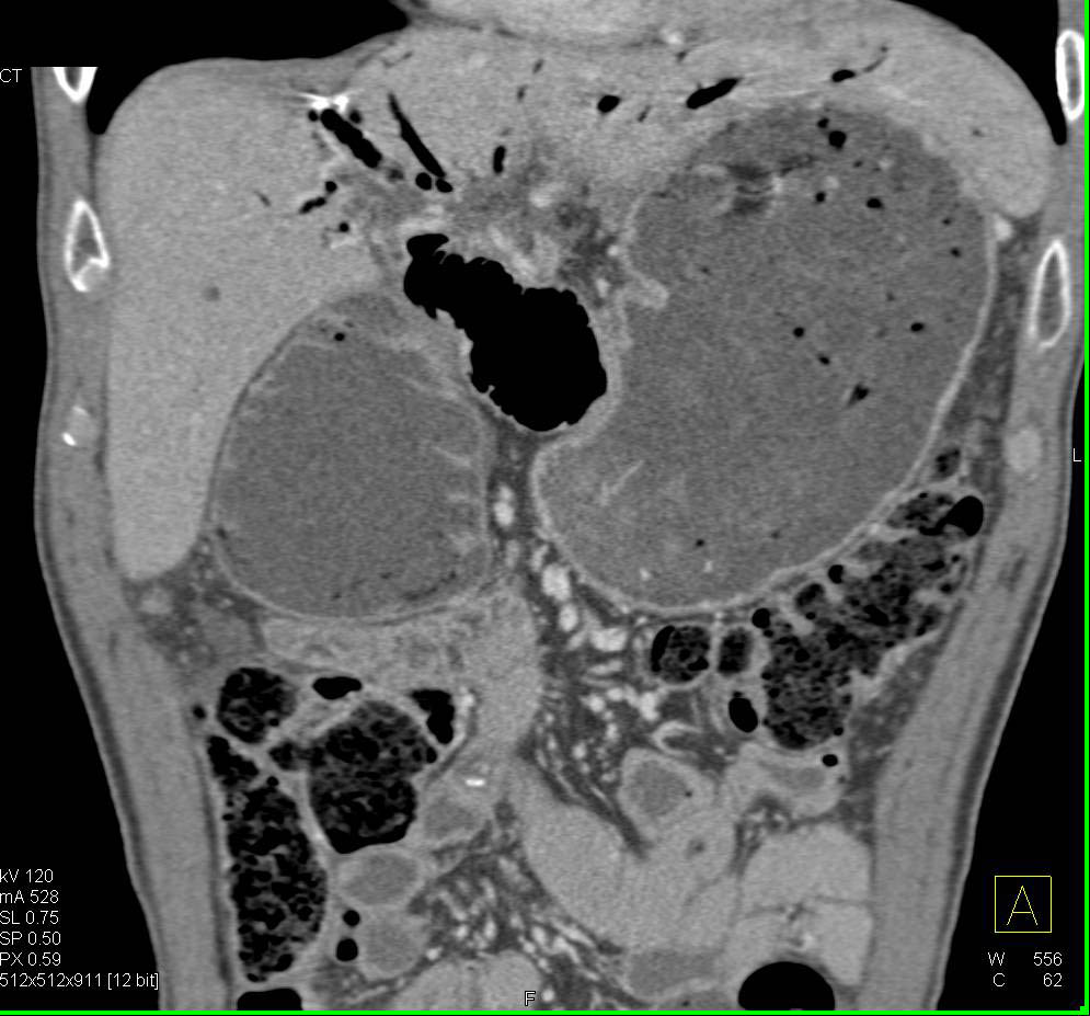 Obstruction of the Gastrojejunostomy Loop - CTisus CT Scan