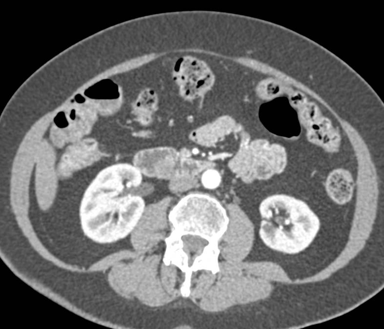 Adenomatous Polyps in the Duodenum - CTisus CT Scan