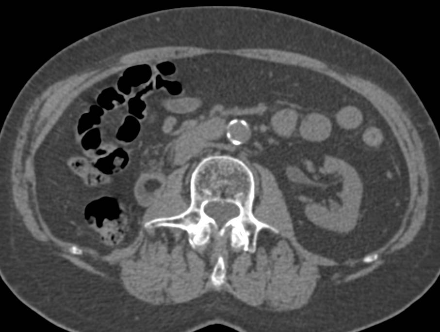 Incidental Duodenal Lipoma - CTisus CT Scan