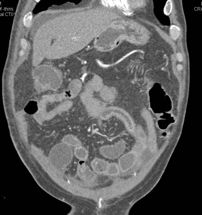 Focal Ischemic Bowel - CTisus CT Scan