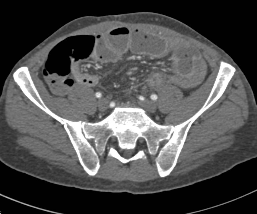 Active Crohn's Disease with Strictures, Prominent Vasa Recta Seen with CT Enterography - CTisus CT Scan