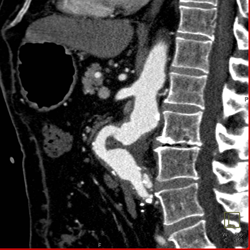 Aorto-enteric Fistulae Involves the Duodenum - CTisus CT Scan