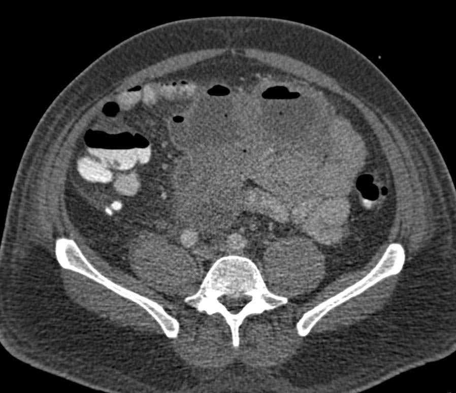 Necrotic Small Bowel GIST Tumor - CTisus CT Scan