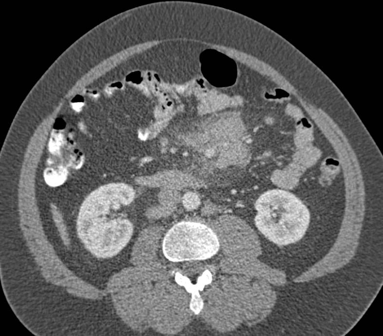 Lymphoma with Nodes in the Root of the Mesentery - CTisus CT Scan