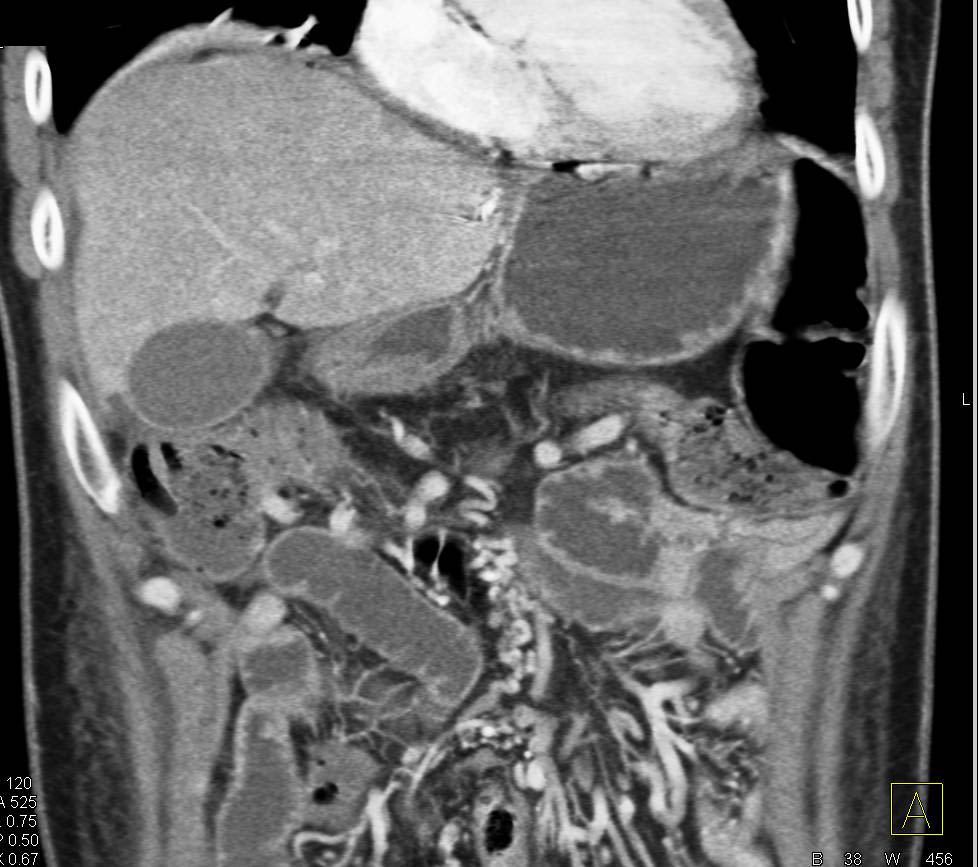 Ischemic Small Bowel with Developing Small Bowel Obstruction (SBO) - CTisus CT Scan