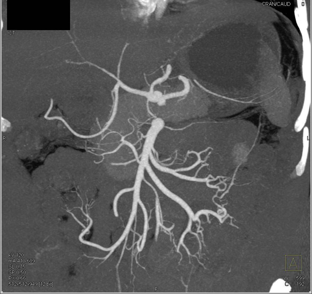 CTA of Mesenteric Arterial and Venous Arcade - CTisus CT Scan