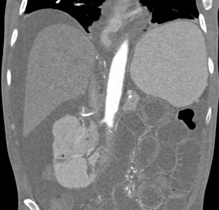 Small Bowel Obstruction due to Internal Hernia - CTisus CT Scan