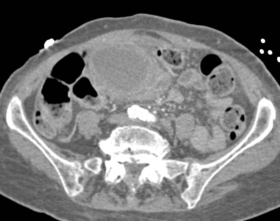 Abscess in the Root of the Mesentery Following Pancreatitis - CTisus CT Scan