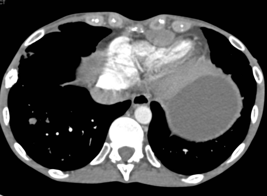 Metastatic Melanoma with Small Bowel Intussusception, Liver Metastases and Subcutaneous Nodules - CTisus CT Scan