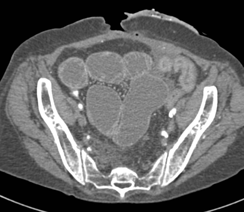 Small Bowel Obstruction (SBO) due to a Stricture - CTisus CT Scan