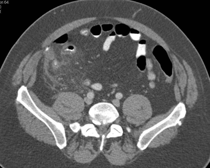 Acute Appendicitis - CTisus CT Scan