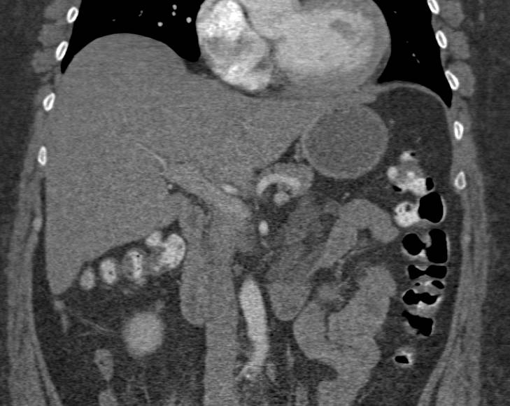 Mesenteric Nodes Due to Mycobacterium avium/intracellulare (MAI) Infection - CTisus CT Scan