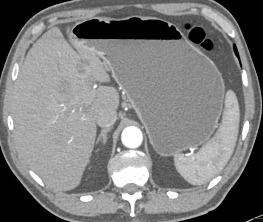 Duodenal Carcinoma with Liver Metastases. The Tumor Obstructs the Stomach. - CTisus CT Scan