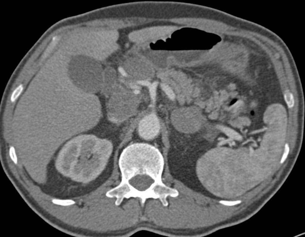 Bulky Duodenal Adenocarcinoma - CTisus CT Scan