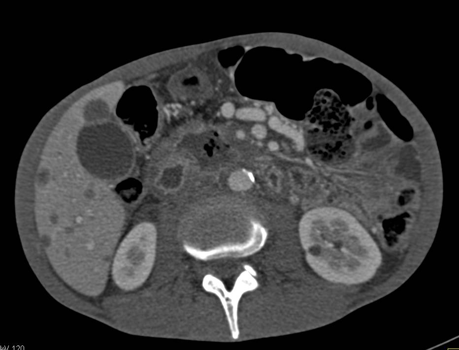 Necrotic Duodenal Adenocarcinoma with Liver Metastases - CTisus CT Scan