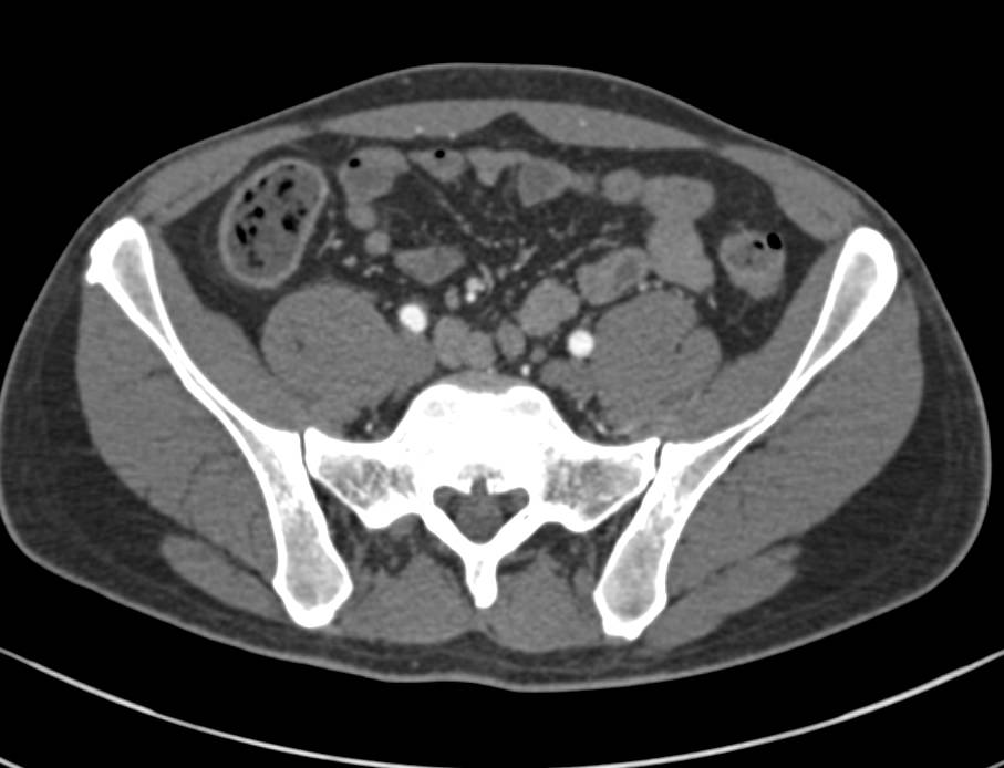 CT Enteroclysis with 3D Mapping Shows Evidence of Abnormally Enhancing Terminal Ileum with Prominent Vasa Recta due to Crohn's Disease - CTisus CT Scan