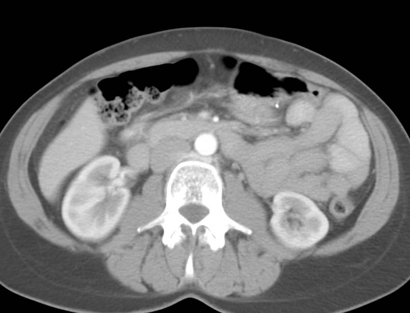 Unopacified Small Bowel Simulates Pathology - CTisus CT Scan